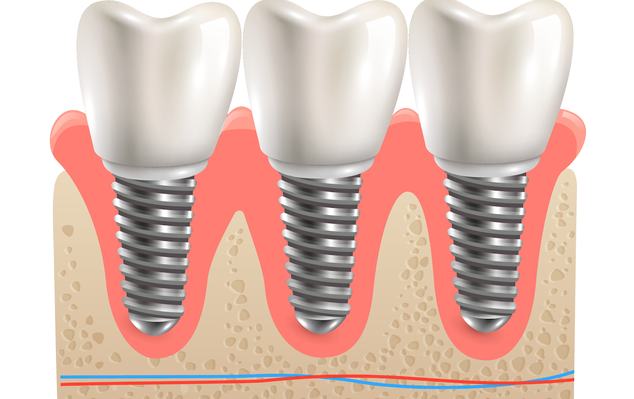 Implantes Dentales